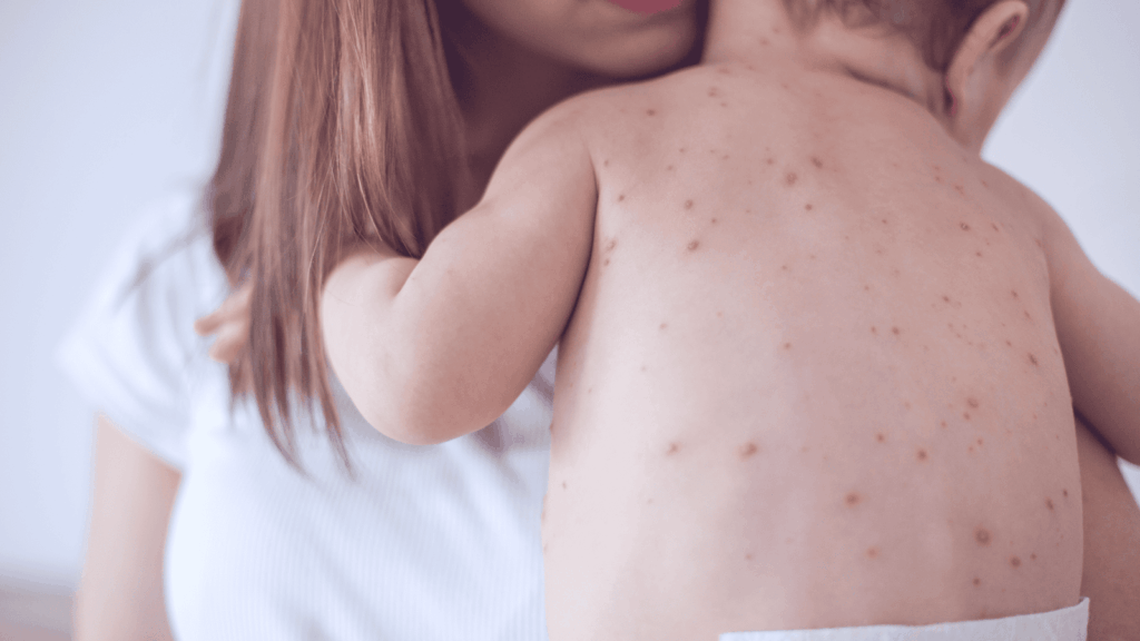 A mother holds a baby whose back is covered in chicken pox